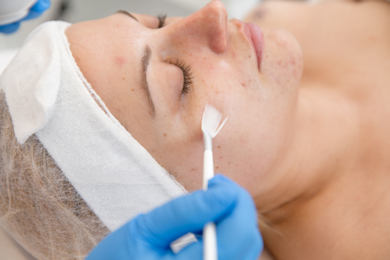 Chemical Peels