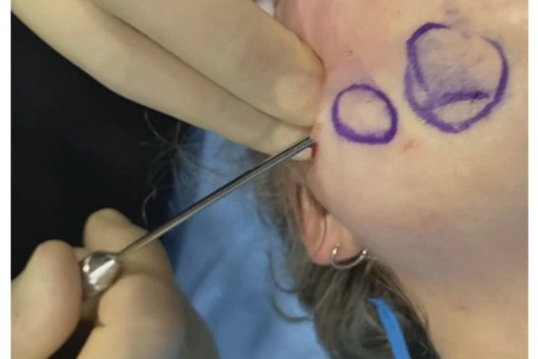 subcision treatment