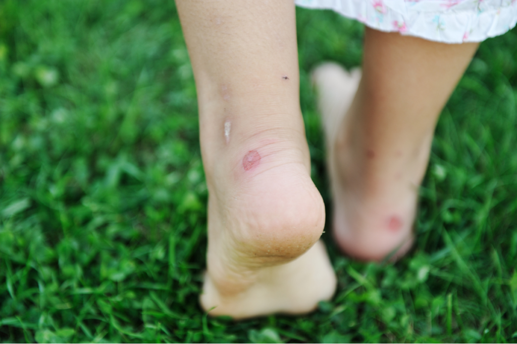 Corn Callus: Restoring Comfort to Your Feet