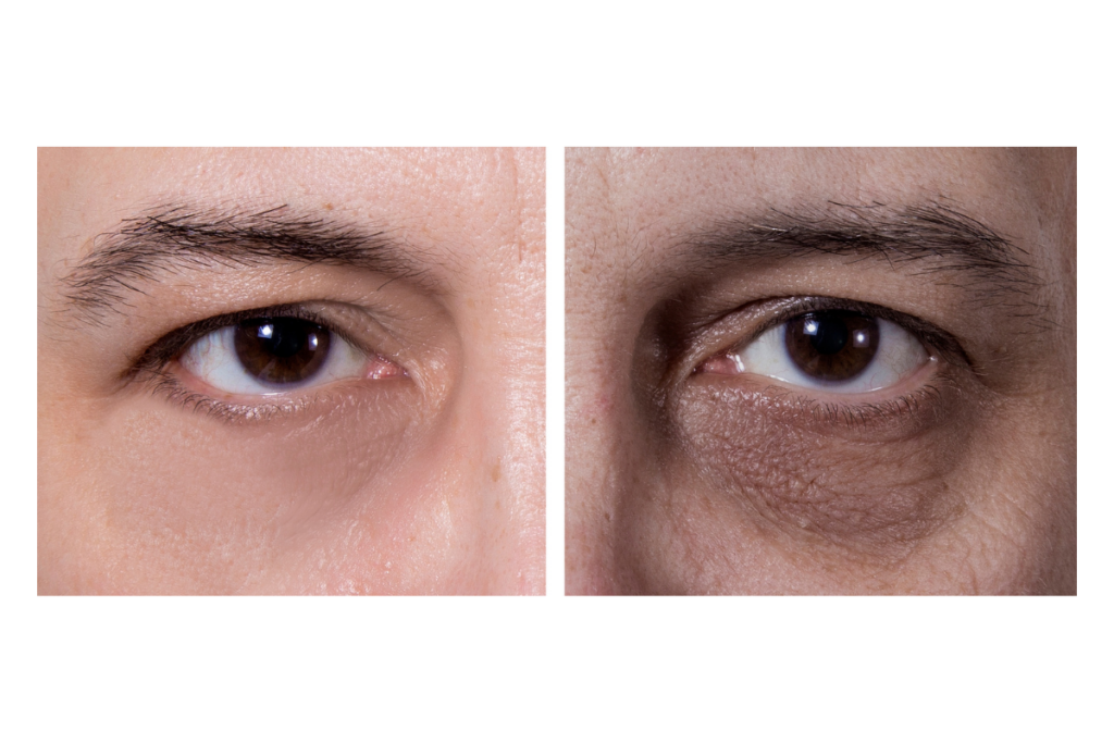 Dark Circles_ Rejuvenating Tired Eyes​