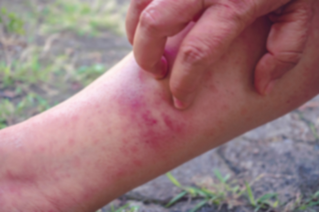 Eczema: Soothing and Managing Itchy Skin