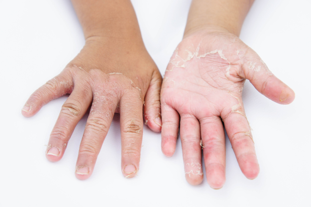 Fungal Infection: Restoring Skin Health​