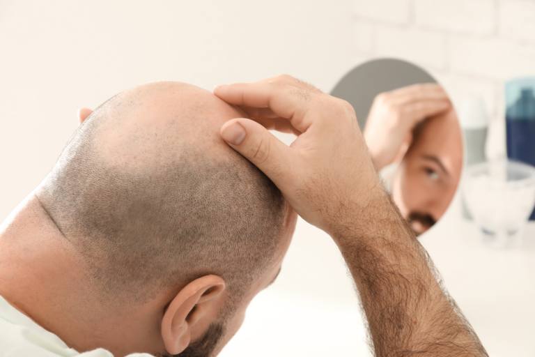 Hair Regrowth