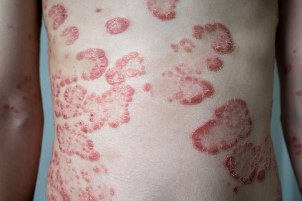Psoriasis Managing Chronic Skin Inflammation_