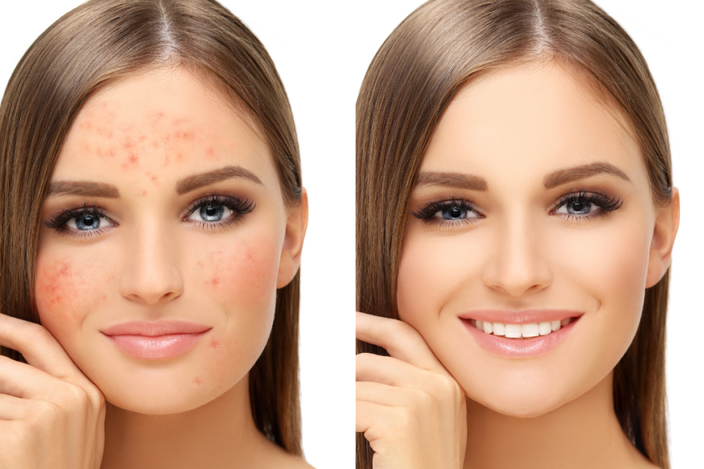 Rosacea: Calming Redness and Facial Flushing
