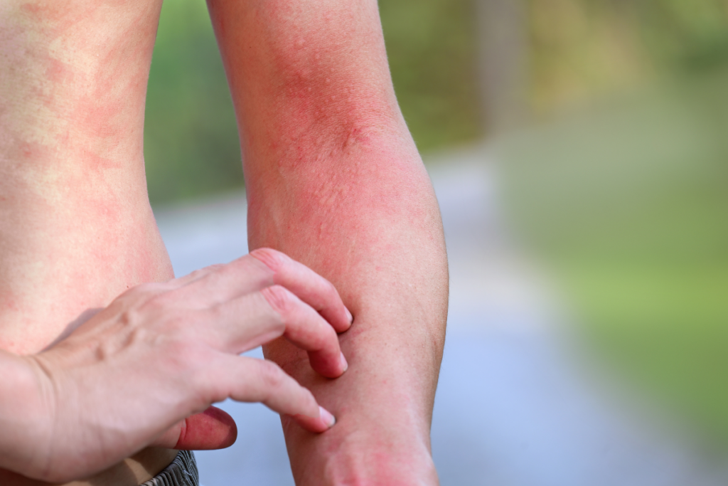 Urticaria: Relieving Itchy Hives​