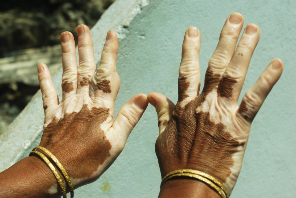 Vitiligo Restoring Skin Color and Confidence_