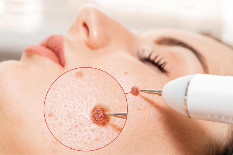 Warts & Skin Tags: Removing Unwanted Blemishes​
