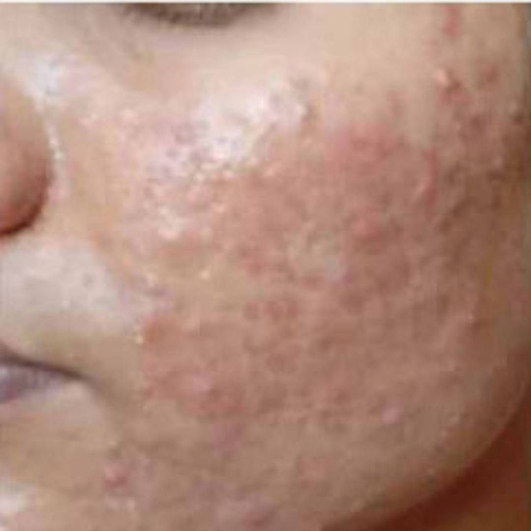 Acne & Acne Scars Unveiling Clearer Skin_ (1)