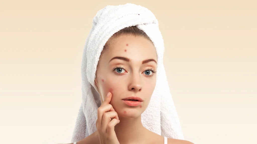 Understanding Acne