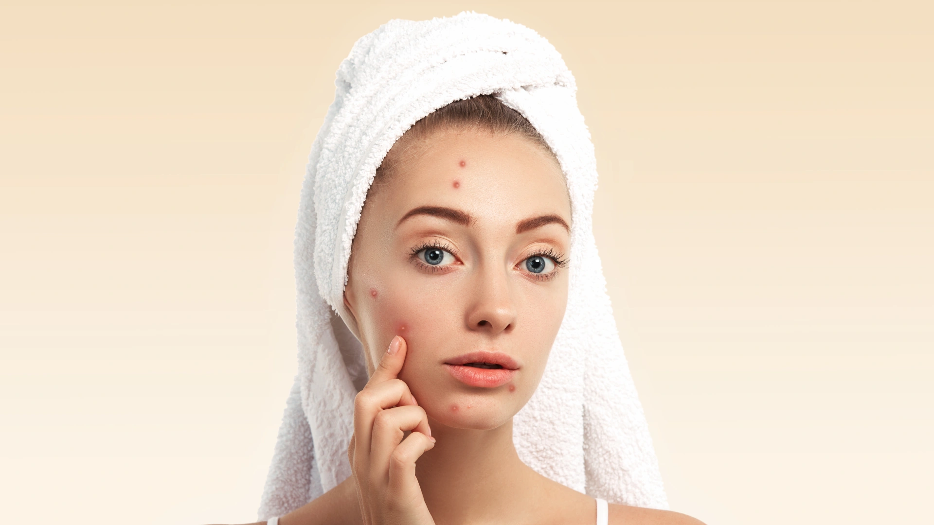 Understanding Acne 