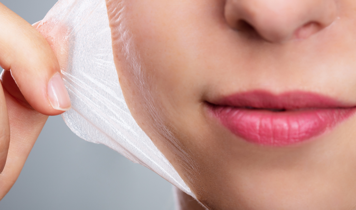 Chemical Peels